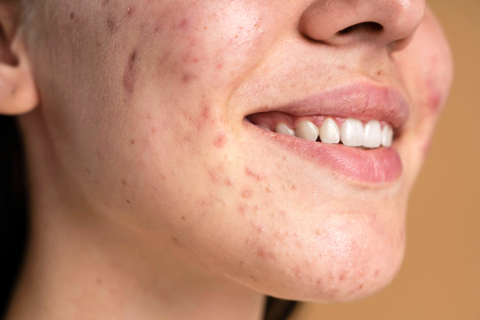 acne-2-2 copy.webp