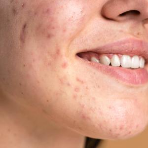 Acné Hormonale : Causes, Solutions et Produits Adaptés chez Para Mall Discount