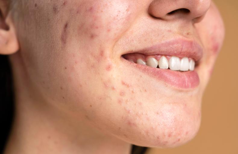 Acné Hormonale : Causes, Solutions et Produits Adaptés chez Para Mall Discount